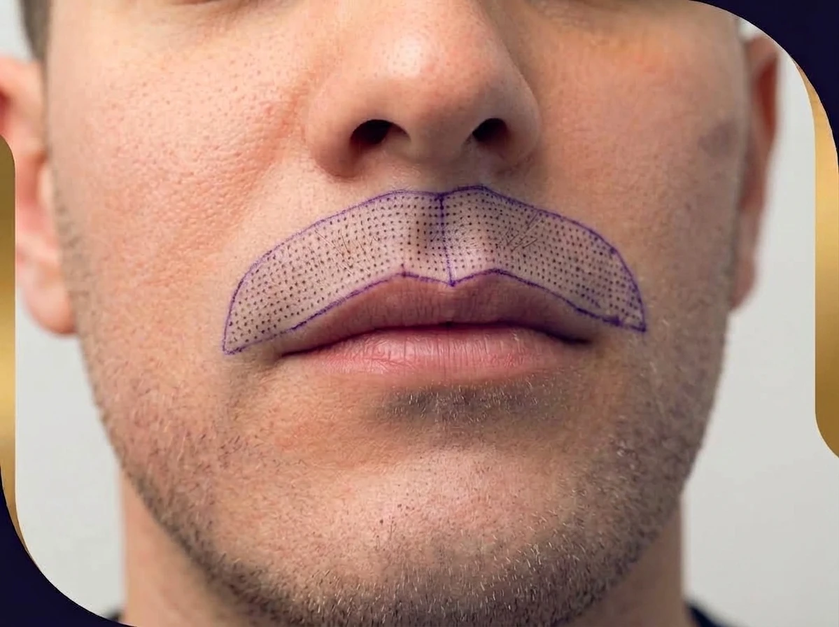Mustache transplant map