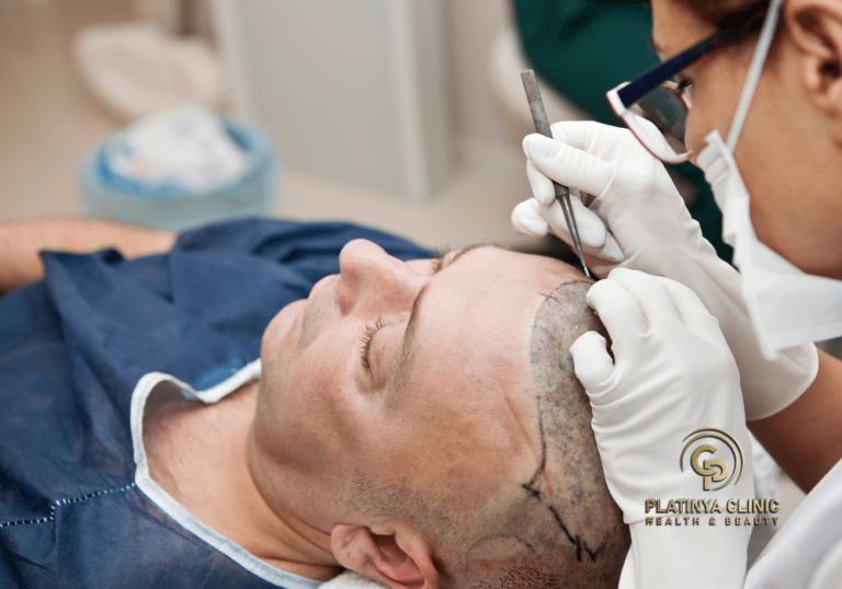 زراعة الشعر بتقنية DHI 