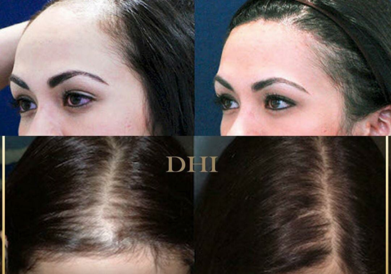 زراعة الشعر للنساء