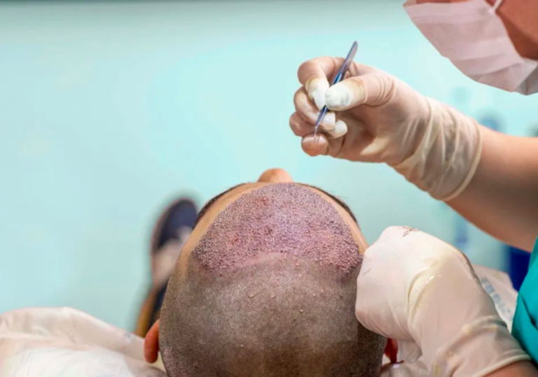 زراعة الشعر بتقنية الهايبرد